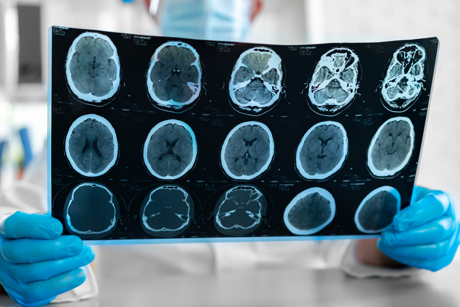 Head Disability Securing a VA Disability Rating for Neurological Disorders